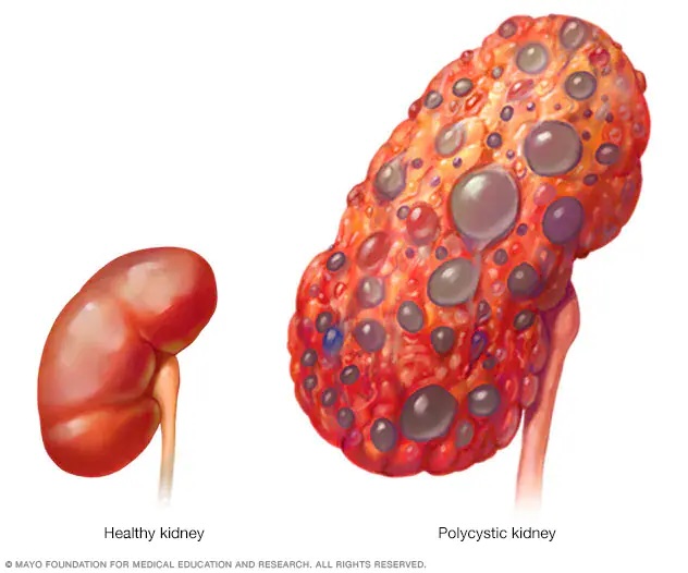 Healthy versus polycystic kidney